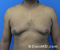 <?php echo $pk; ?> - Surgery for Gynecomastia View Before 4 - 1