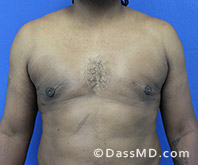 <?php echo $pk; ?> - Surgery for Gynecomastia View After 4 - 1