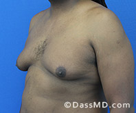 <?php echo $pk; ?> - Surgery for Gynecomastia View Before 4 - 2