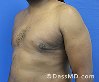 <?php echo $pk; ?> - Surgery for Gynecomastia View After 4 - 2