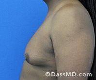 <?php echo $pk; ?> - Surgery for Gynecomastia View Before 4 - 3