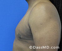 <?php echo $pk; ?> - Surgery for Gynecomastia View After 4 - 3