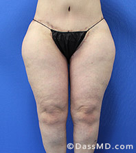 Dr Dennis Dass, MD  Thigh Lift After view 1