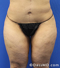 Dr Dennis Dass, MD  Thigh Lift After view 2 - 1