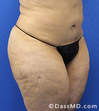 Dr Dennis Dass, MD  Thigh Lift After view 2 - 2