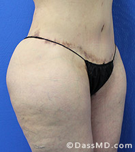 Dr Dennis Dass, MD  Thigh Lift After view 2