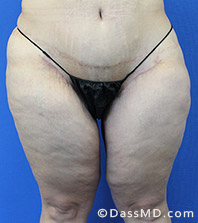 Dr Dennis Dass, MD  Thigh Lift After view 3 - 1