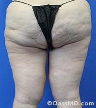 Dr Dennis Dass, MD Thigh Lift After view 3 - 2