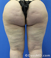 Dr Dennis Dass, MD Thigh Lift After view 3