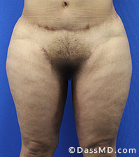 Dr Dennis Dass, MD  Thigh Lift After view 4 - 1