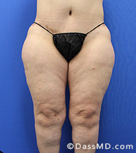Dr Dennis Dass, MD Thigh Lift Before view 1