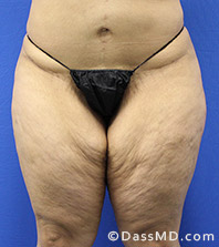 Dr Dennis Dass, MD Thigh Lift Before view 2 - 1