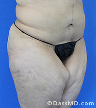Dr Dennis Dass, MD Thigh Lift Before view 2 - 2