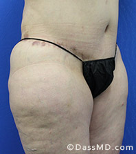 Dr Dennis Dass, MD  Thigh Lift Before view 2