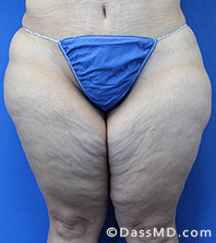 Dr Dennis Dass, MD  Thigh Lift Before view 3 - 1