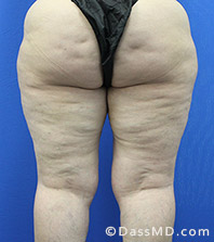 Dr Dennis Dass, MD Thigh Lift Before view 3