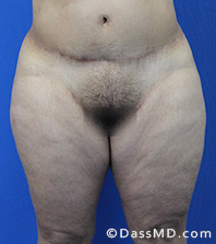 Dr Dennis Dass, MD  Thigh Lift Before view 4 - 1
