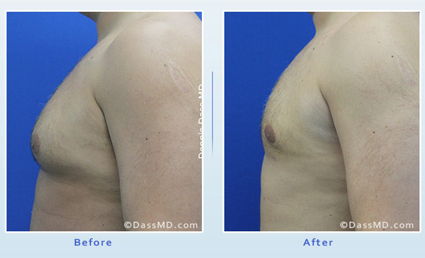 Dr Dennis Dass, MD Chest Liposuction