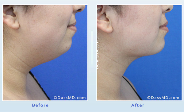 Dr Dennis Dass, MD Thigh Liposuction