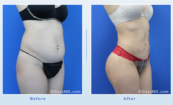 Dr Dennis Dass, MD Liposuction Fat transfer to Buttock