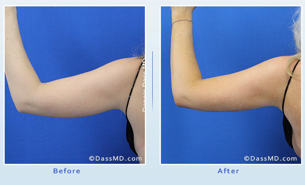 Dr Dennis Dass, MD Arm Liposuction