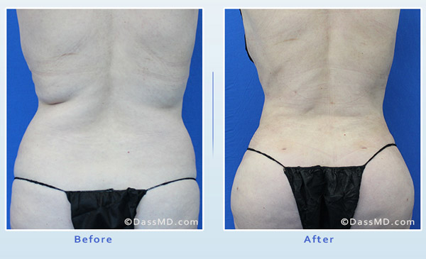 Dr Dennis Dass, MD Back Liposuction