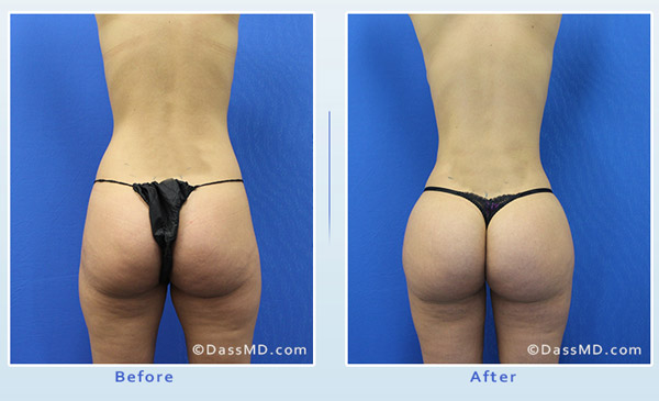 Dr Dennis Dass, MD Thigh Liposuction