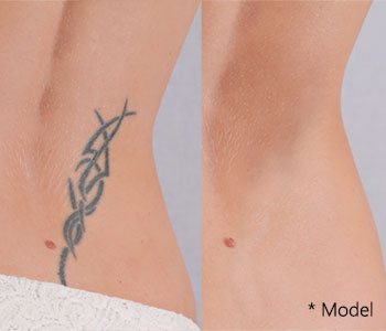 PicoSure tattoo removal near Beverly Hills