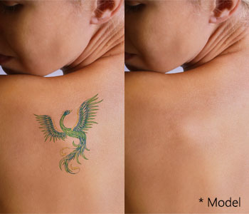 Easier tattoo coverups with the PicoSure tattoo removal near Los Angeles