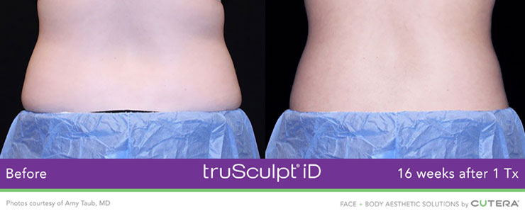 Dr. Dennis Dass, NtruSculpt iD image 1