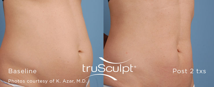 Dr. Dennis Dass, NtruSculpt iD image 2