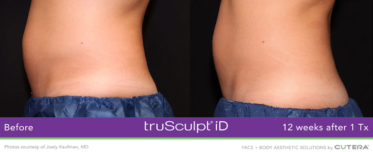 Dr. Dennis Dass, NtruSculpt iD image 7