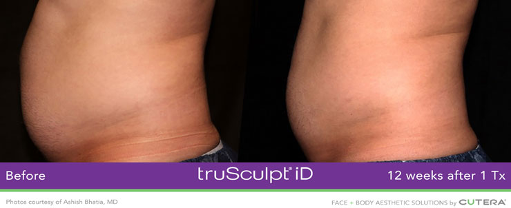 Dr. Dennis Dass, NtruSculpt iD image 8