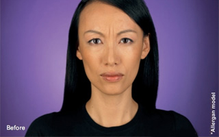 <?php echo $pk; ?> - Botox Image1