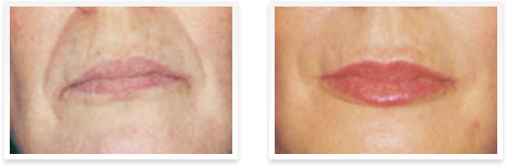 Dermatologist  Downey - Before and after 01