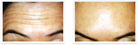 Dermatologist  Downey - Before and after 02