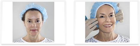 Dermatologist  Downey - Before and after 04