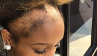 Skin Care Products Montclair - Woman who suffers from hair loss