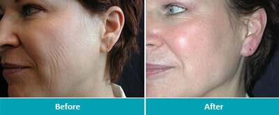Dr. Jeanine Downie Montclair - Before And After 1