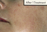 Chemical Peels Before and After 06