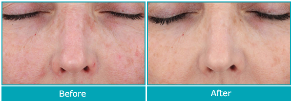 Dr. Jeanine Downie Montclair - Intellishade Original Before and After Images set 1