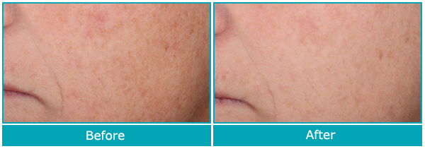 Dr. Jeanine Downie Montclair - Intellishade Original Before and After Images set 2