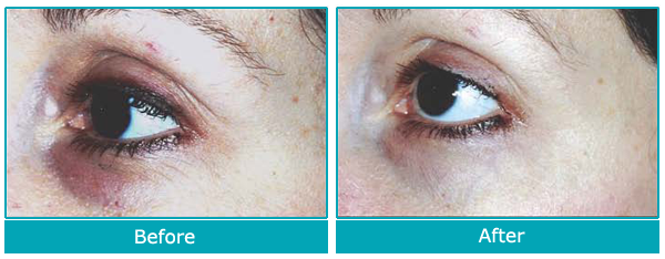 Dr. Jeanine Downie Montclair - Teamine Eye Complex Before and After Images set