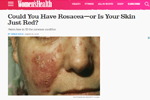 Could You Have Rosacea—or Is Your Skin Just Red? - Women's Health