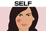 Eczema Treatment, What You Can Do To Stop The Incessant Itch