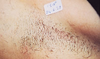 Laser hair removal 