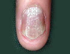 Patient with psoriasis 03