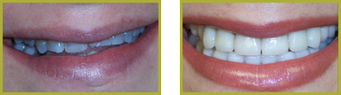 Restorative Dentistry Wayne - Restorative Dentistry Before and After Case 03