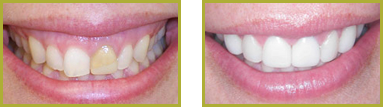 Restorative Dentistry Wayne - Restorative Dentistry Before and After Case 01