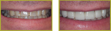 Restorative Dentistry Wayne - Restorative Dentistry Before and After Case 12
